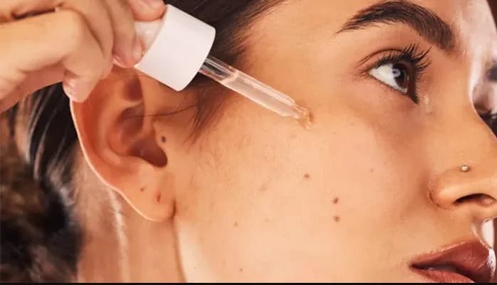 Blackheads, Whiteheads or Cysts? A Simple Guide to Identifying Your Acne Type (by Delhi’s Best Dermatologist)