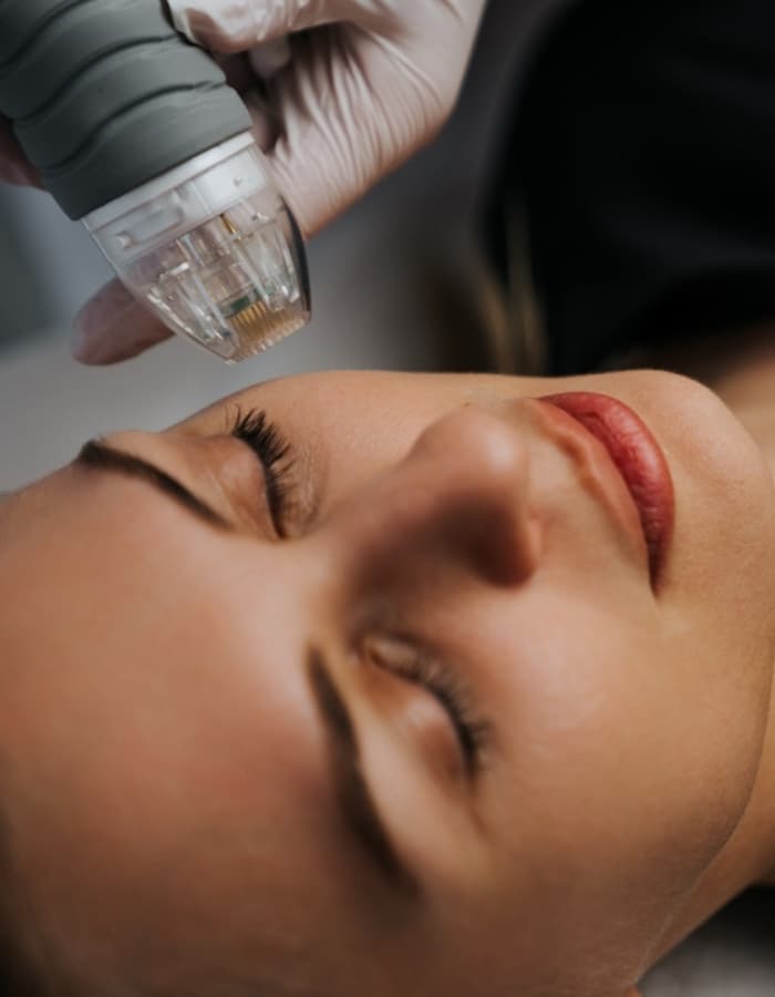 Microneedling (MNRF) Treatment Clinic in Delhi