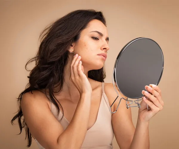 Pimple & Acne Scars Treatment Clinic in Delhi video