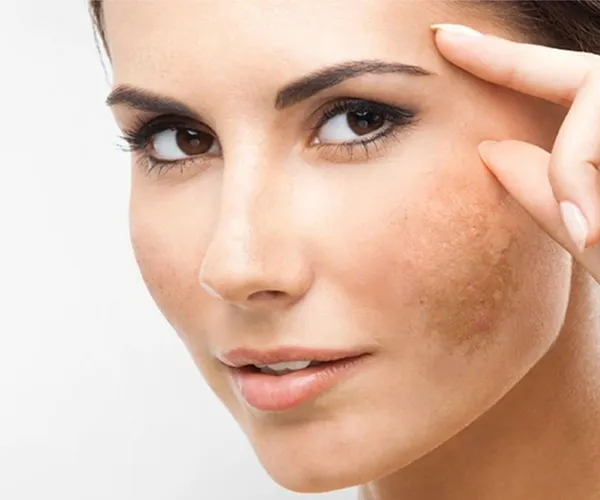 Melasma Treatment Clinic in Delhi video