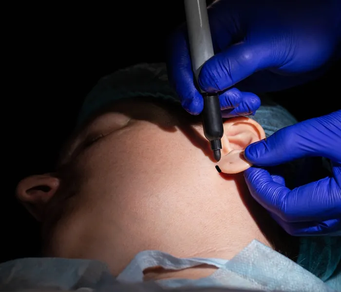 Ear Lobe Repair Surgery Treatment in Delhi, India video