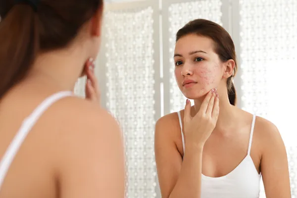 Acne Scar Treatment