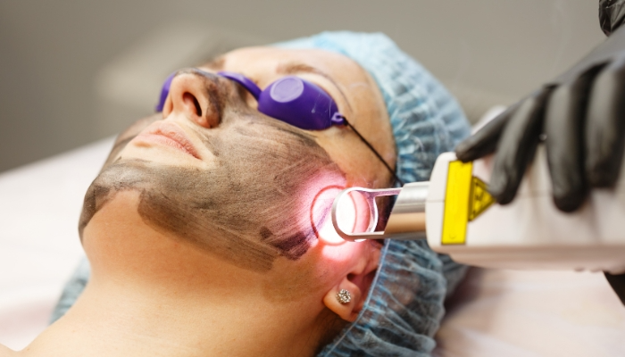 Best Pico Laser Treatment for Skin in Delhi video