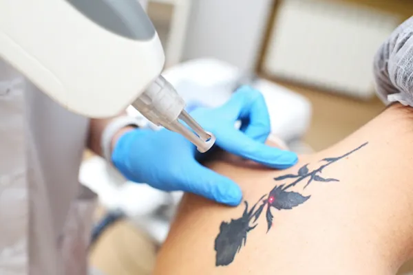 Tattoo Removal
