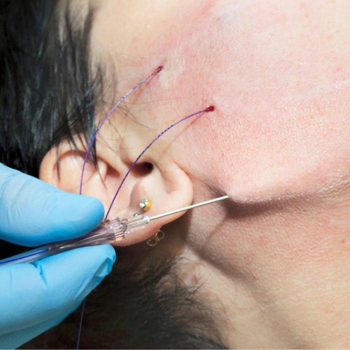 Thread Lift Treatment Clinic in Delhi video